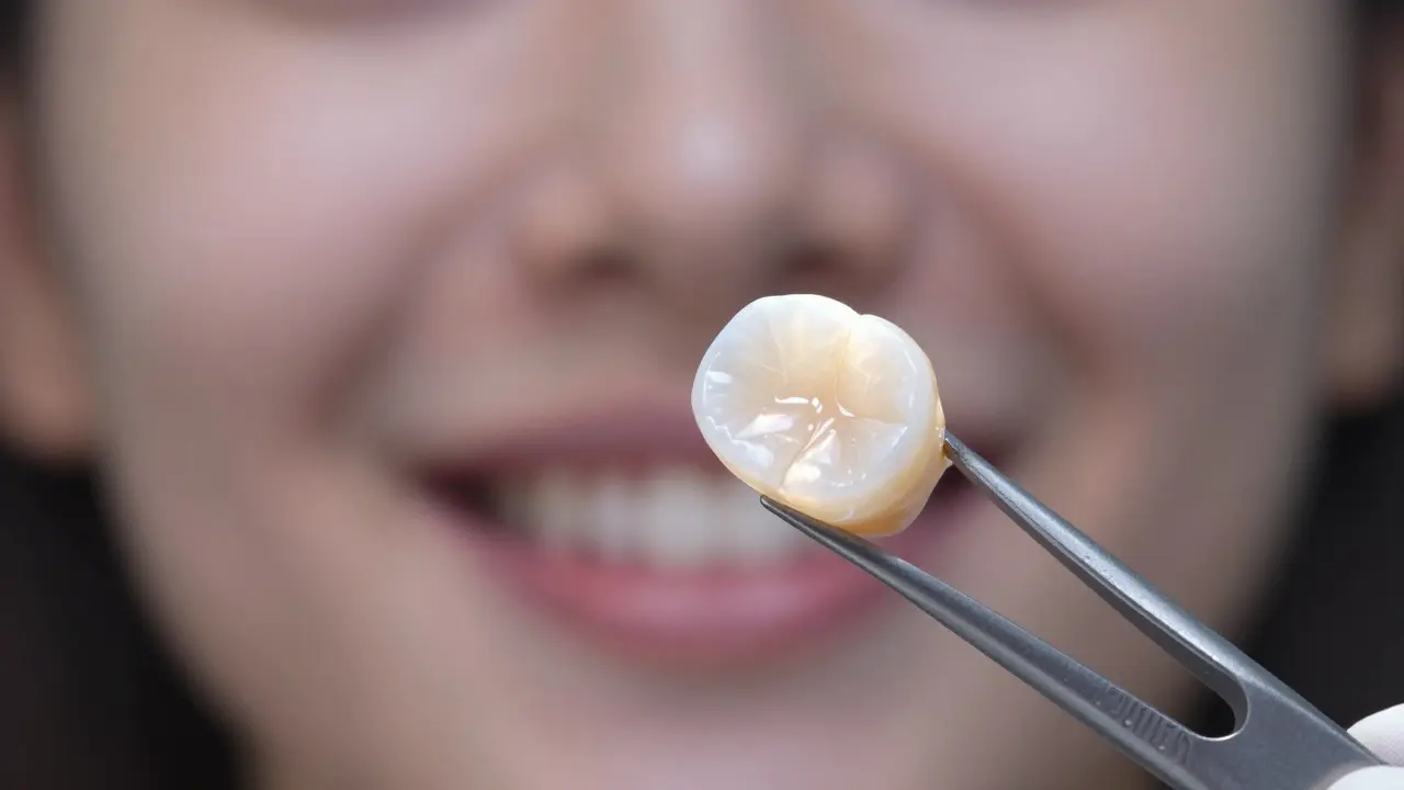 A ceramic dental veneer held in tweezers, backlit by sunlight, showing its translucency and seamless fit.